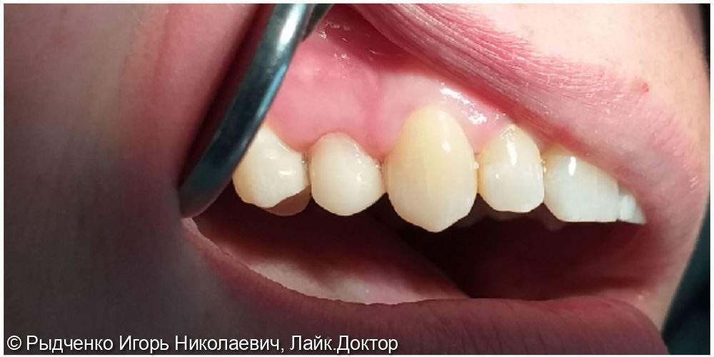 После
