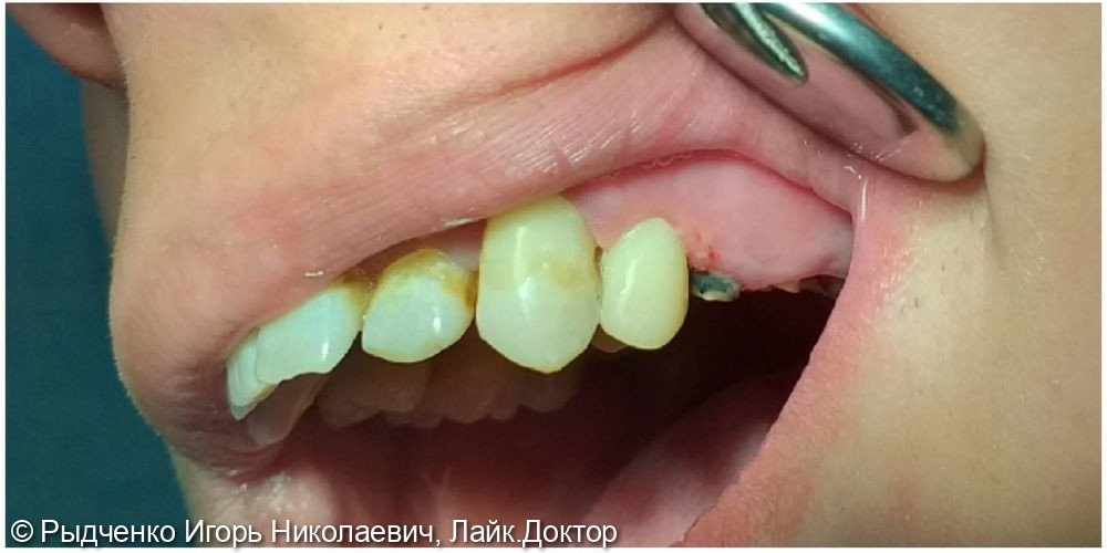 Лечение пульпитного 2.4. зуба, с последующим восстановлением с помощью стекловолоконного анкера из светокомпозита - фото №3