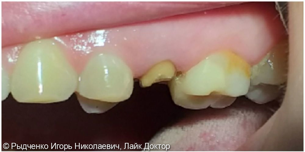 Восстановление малого коренного верхнего зуба на основе вылеченного корня из светокомпозита, с использованием анкерных штифтов - фото №1