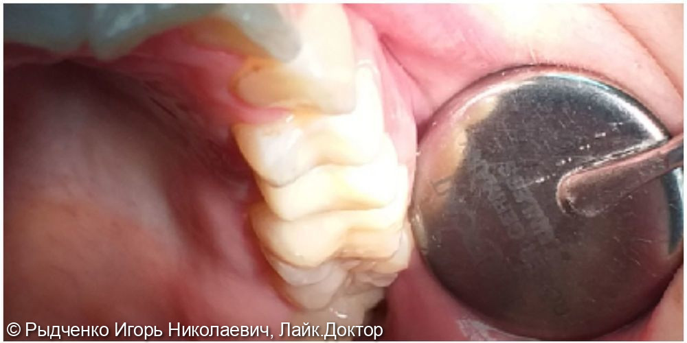Восстановление малого коренного верхнего зуба на основе вылеченного корня из светокомпозита, с использованием анкерных штифтов - фото №2