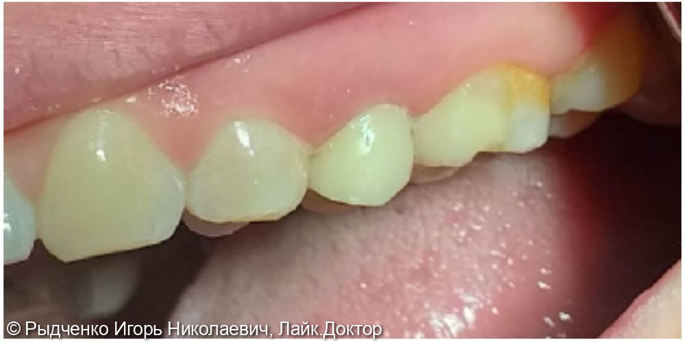 Восстановление малого коренного верхнего зуба на основе вылеченного корня из светокомпозита, с использованием анкерных штифтов - фото №3