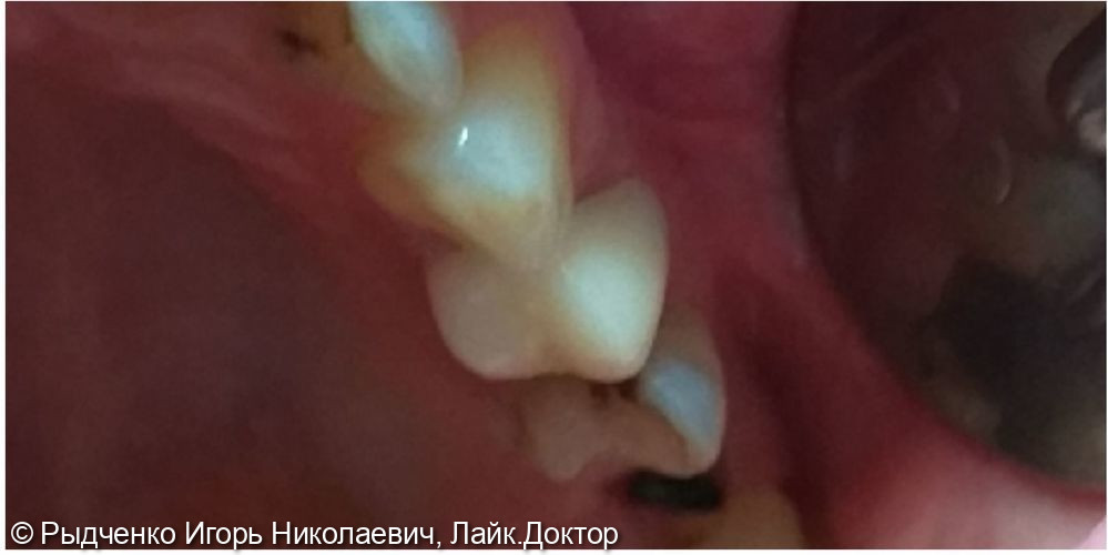 Восстановление коронковой части малого коренного зуба верхней челюсти на основе анкерных штифтов зафиксированных в корневые каналы из композита светового отверждения - фото №3