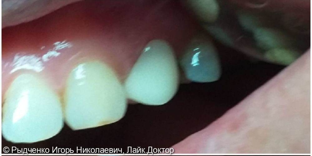 Восстановление коронковой части малого коренного зуба верхней челюсти на основе анкерных штифтов зафиксированных в корневые каналы из композита светового отверждения - фото №4