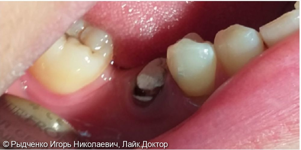 Эстетическое восстановление полностью разрушенного малого коренного зуба нижней челюсти на основе вылеченного корня - фото №1