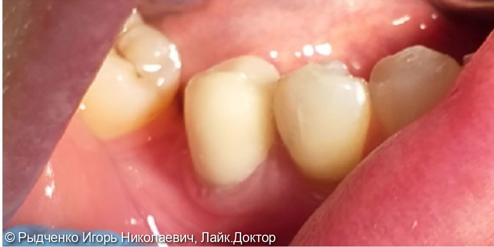 Эстетическое восстановление полностью разрушенного малого коренного зуба нижней челюсти на основе вылеченного корня - фото №3