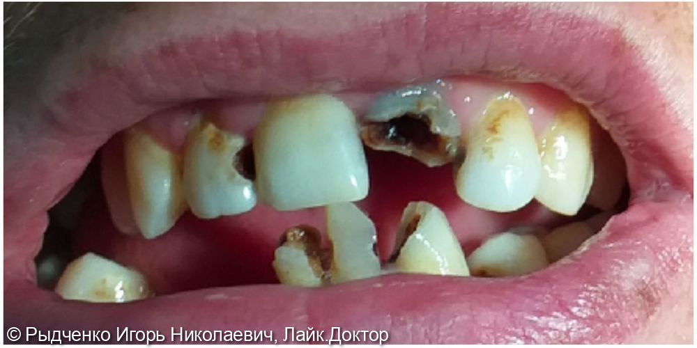 Лечение множественного кариеса фронтальных зубов верхней челюсти - фото №1
