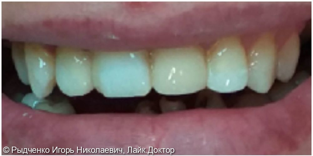 Лечение множественного кариеса фронтальных зубов верхней челюсти - фото №2