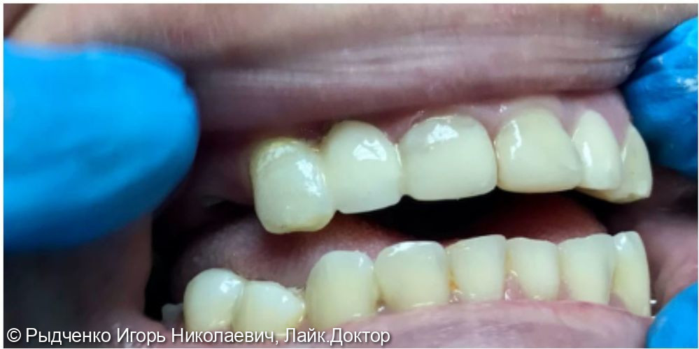 Микропротезирование с использованием адгезивной стекловолоконной методики восстатовления зубов из светокомпозита - фото №3