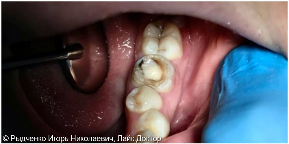 Лечение вторичного кариеса коренного зуба нижней челюсти - фото №1