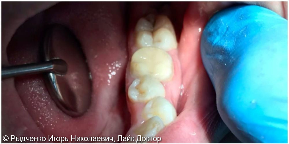 Лечение вторичного кариеса коренного зуба нижней челюсти - фото №3