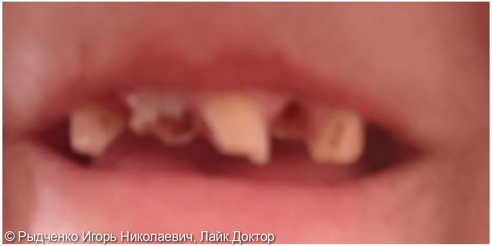 Комбинированное лечение зубов с множественным кариозными поражениями, с осложнениями ( хронический периодонтит). Восстановление анатомической формы зубов фронтального отдела верхней челюсти из светокомпозита - фото №1