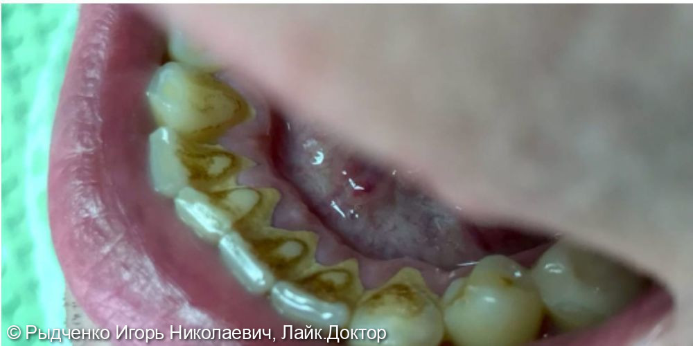 Профессиональная гигиена зубов - фото №1