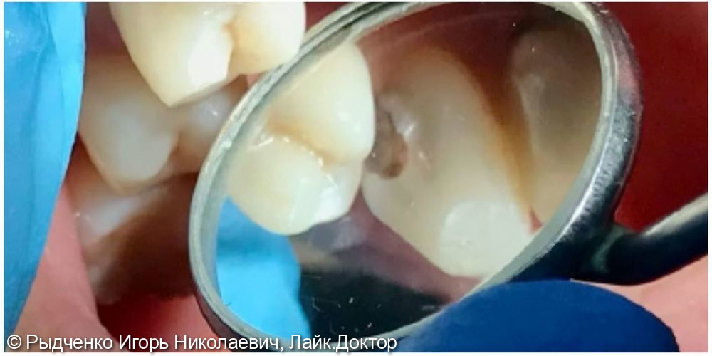 Лечение клиновидного дефекта 1.4 зуба и глубокого кариеса 1.3 зуба одновременно из светокомпозита - фото №2