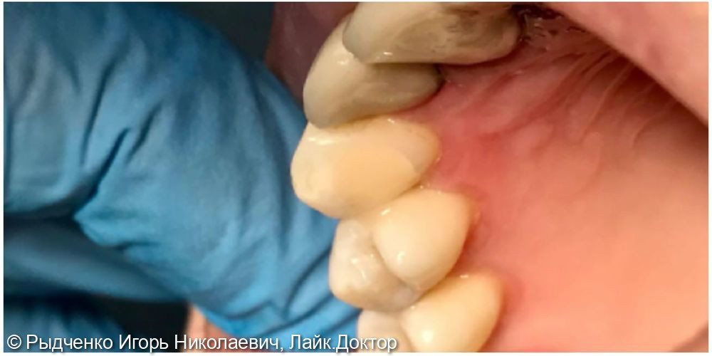Лечение клиновидного дефекта 1.4 зуба и глубокого кариеса 1.3 зуба одновременно из светокомпозита - фото №3