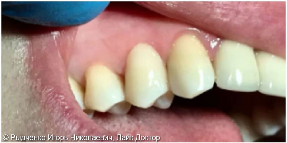 Лечение клиновидного дефекта 1.4 зуба и глубокого кариеса 1.3 зуба одновременно из светокомпозита - фото №4