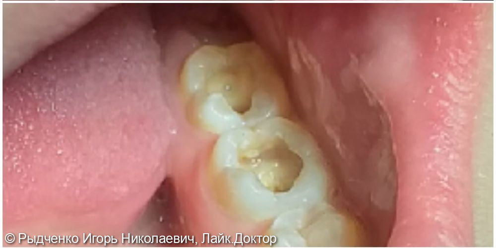Лечение глубокого кариеса 3.6 и 3.7 зубов, восстановление коронковой части зубов из светокомпозита - фото №1