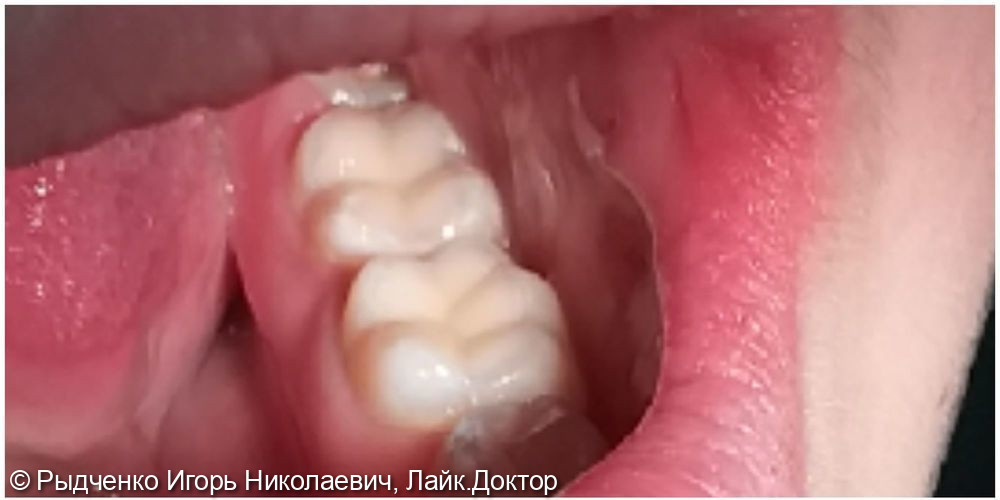Лечение глубокого кариеса 3.6 и 3.7 зубов, восстановление коронковой части зубов из светокомпозита - фото №2
