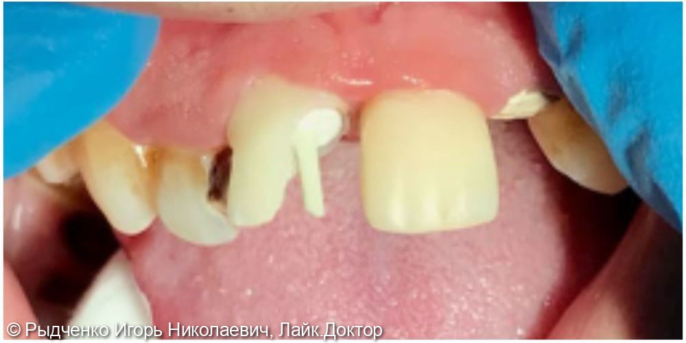 Лечение, восстановление передних зубов верхней челюсти из светокомпозита - фото №3
