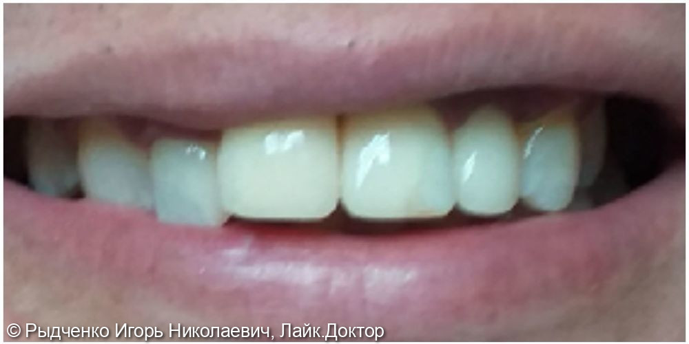Лечение, восстановление передних зубов верхней челюсти из светокомпозита - фото №5