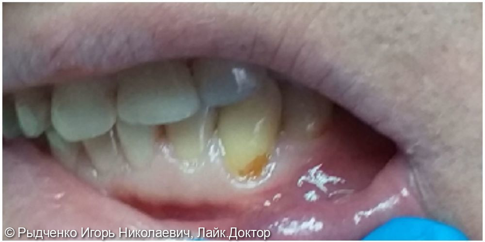 Лечение пришеечного кариеса 3.3 зуба - фото №1