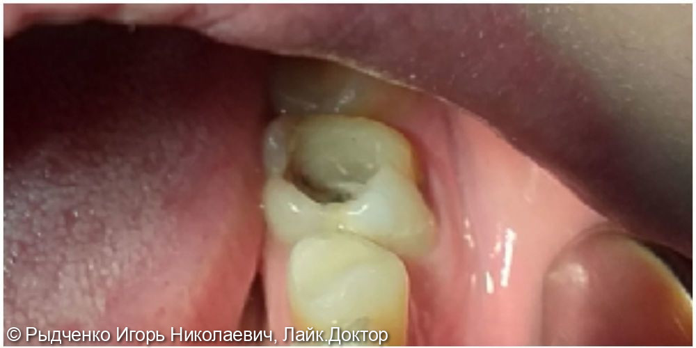 Лечение нижнего коренного зуба с обострением хронического периодонтита - фото №1