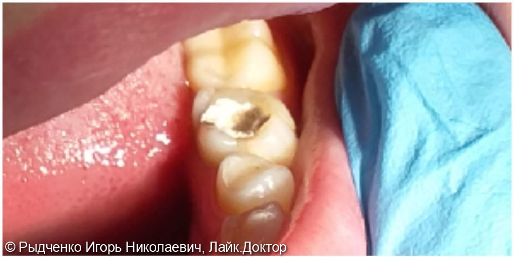 Лечение нижнего коренного зуба с обострением хронического периодонтита - фото №2