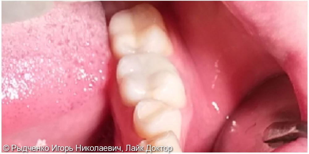 Лечение нижнего коренного зуба с обострением хронического периодонтита - фото №3