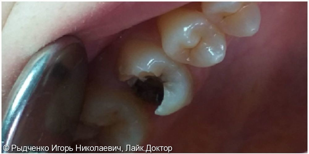 Лечение пульпита верхнего коренного зуба - фото №1
