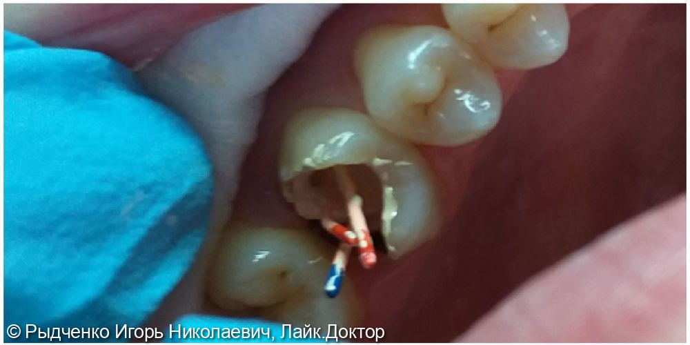 Лечение пульпита верхнего коренного зуба - фото №2