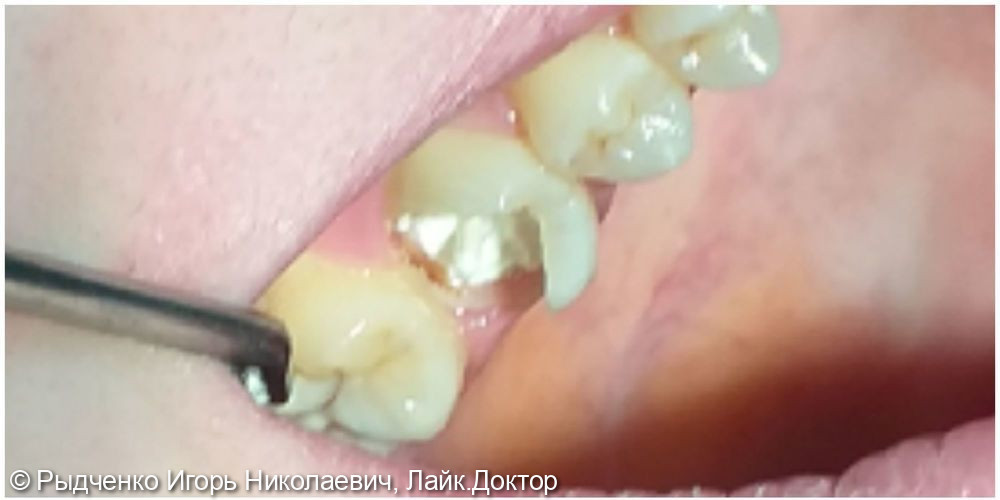 Лечение пульпита верхнего коренного зуба - фото №3