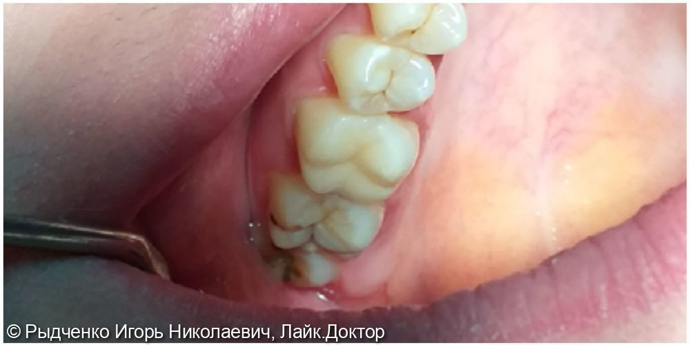 Лечение пульпита верхнего коренного зуба - фото №4