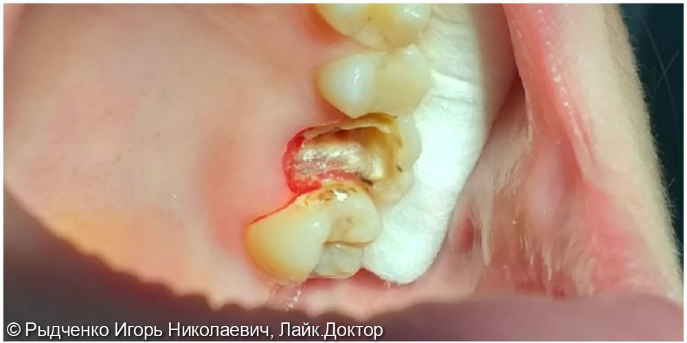 Лечение хронического периодонтита 2.6 зуба, с последующим восстановлением из светокомпозита на основе анкерных внутриканальных штифтов - фото №1