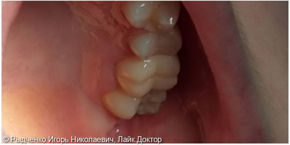 Лечение хронического периодонтита 2.6 зуба, с последующим восстановлением из светокомпозита на основе анкерных внутриканальных штифтов - фото №3