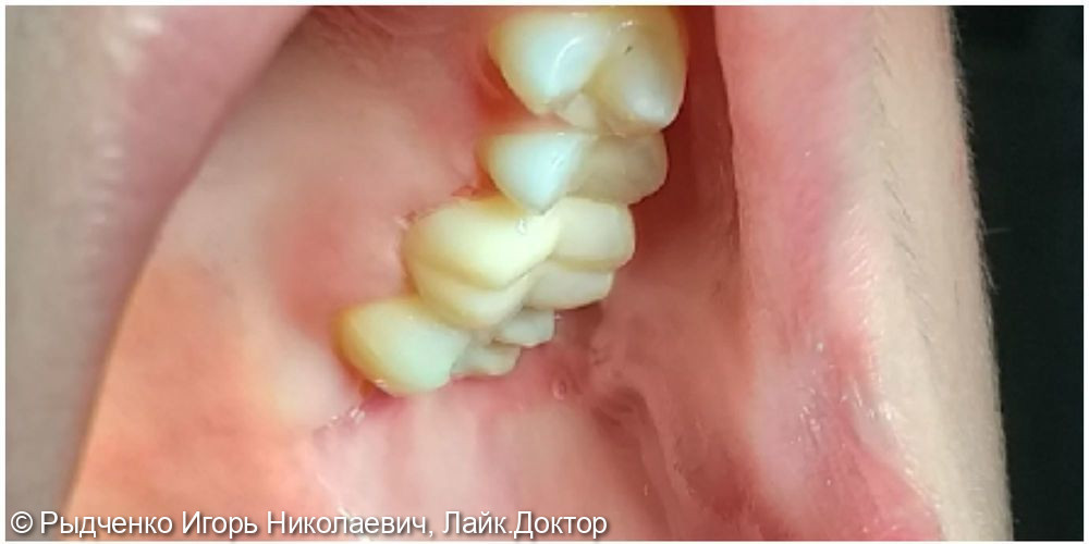 Лечение хронического периодонтита 2.6 зуба, с последующим восстановлением из светокомпозита на основе анкерных внутриканальных штифтов - фото №4