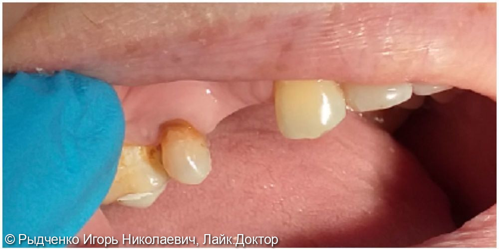 Восстановление разрушенной коронковой части 1.5 зуба, с использованием анкерных штифтов из светокомпозита - фото №1