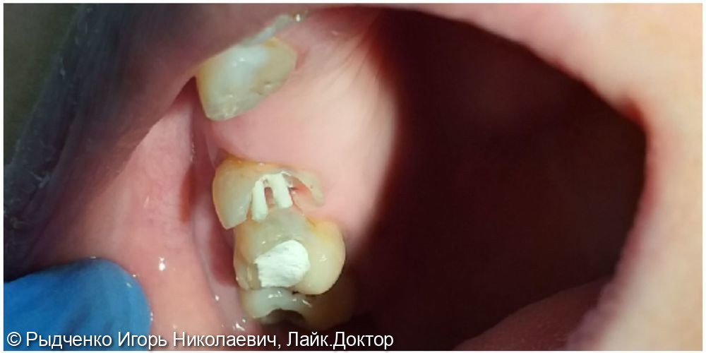 Восстановление разрушенной коронковой части 1.5 зуба, с использованием анкерных штифтов из светокомпозита - фото №2