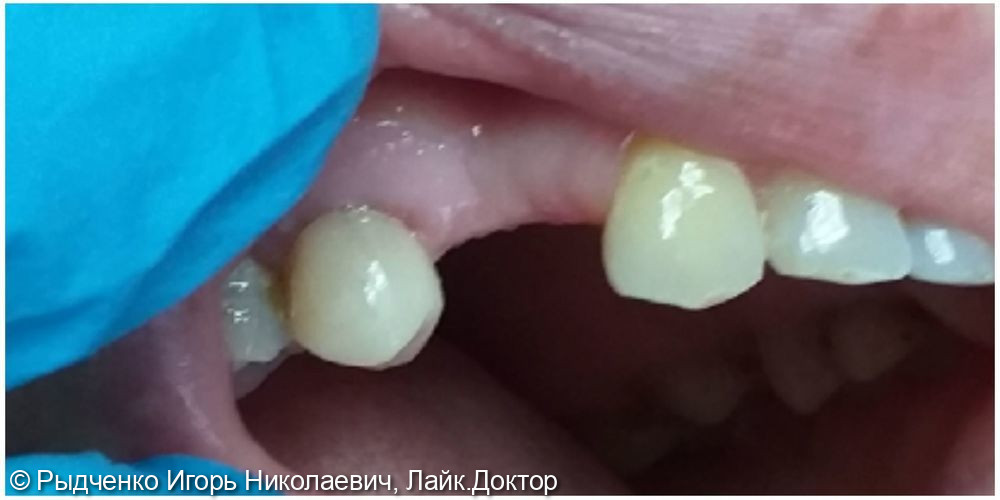 Восстановление разрушенной коронковой части 1.5 зуба, с использованием анкерных штифтов из светокомпозита - фото №3