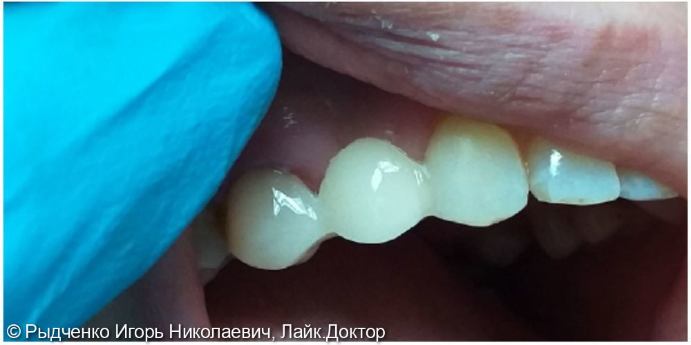 Восстановление разрушенной коронковой части 1.5 зуба, с использованием анкерных штифтов из светокомпозита - фото №4