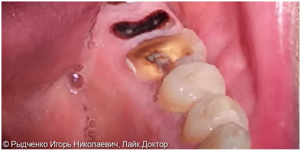 Восстановление полностью разрушенного нижнего коренного зуба на основе сохранёного корня из светокомпозита - фото №1