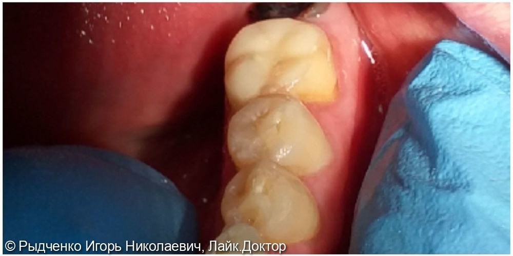 Восстановление полностью разрушенного нижнего коренного зуба на основе сохранёного корня из светокомпозита - фото №3