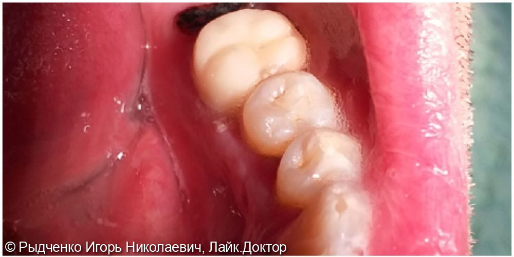 Восстановление полностью разрушенного нижнего коренного зуба на основе сохранёного корня из светокомпозита - фото №4