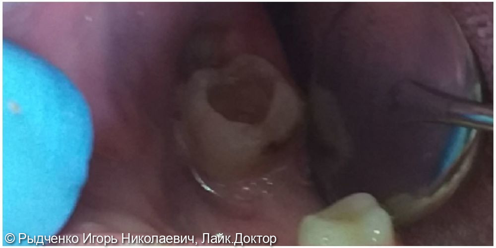 Лечение хронического периодонтита нижнего коренного зуба - фото №1