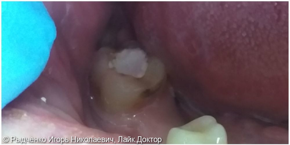 Лечение хронического периодонтита нижнего коренного зуба - фото №2