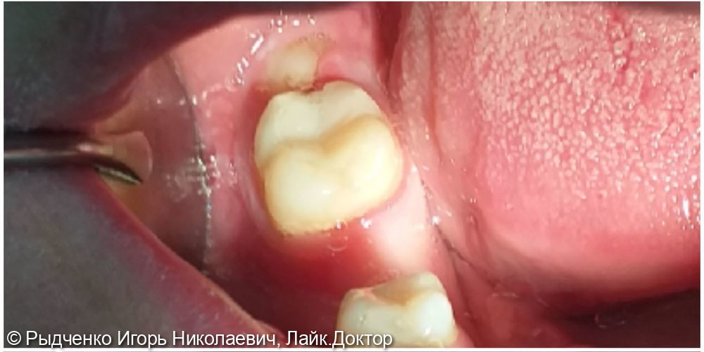 Лечение хронического периодонтита нижнего коренного зуба - фото №3
