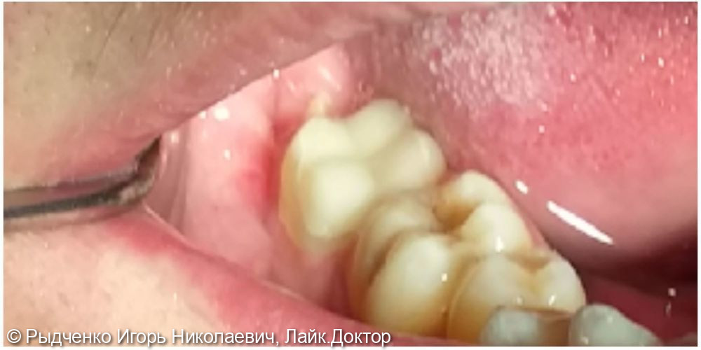Лечение хронического периодонтита нижнего коренного зуба в стадии обострения - фото №5
