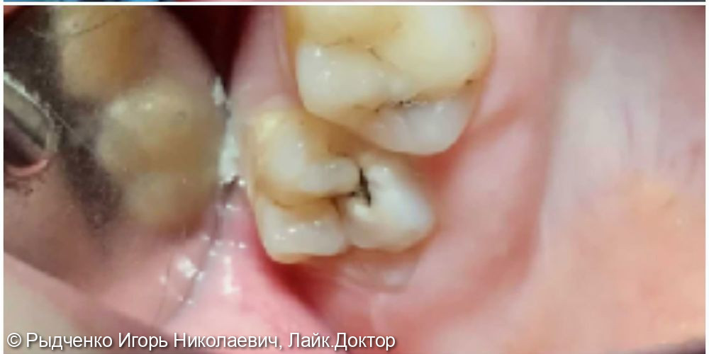 Лечение глубокого кариеса верхних коренных зубов - фото №1