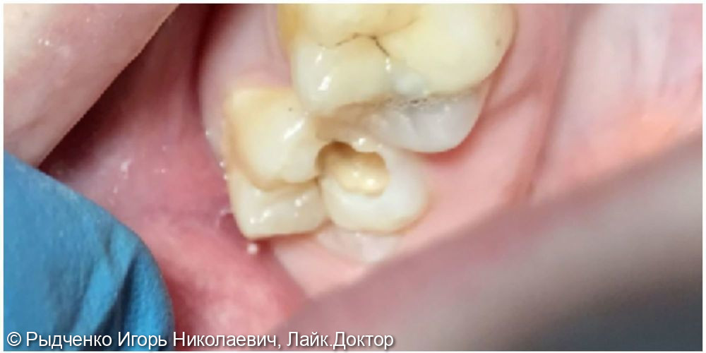 Лечение глубокого кариеса верхних коренных зубов - фото №2