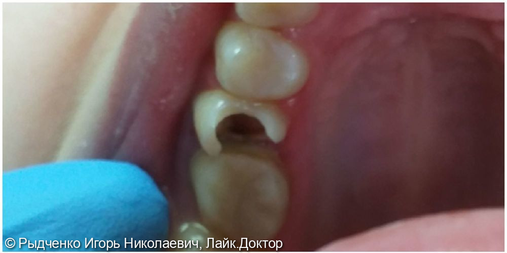 Лечение хронического периодонтита 1.5 зуба с последующим восстановлением из светокомпозита - фото №1