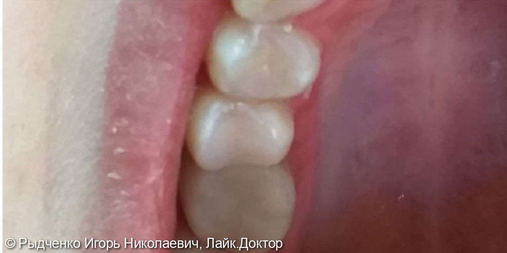 Лечение хронического периодонтита 1.5 зуба с последующим восстановлением из светокомпозита - фото №6