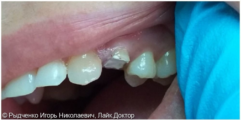 Восстановление полностью разрушенного зуба 2.4 на основе сохранённых, пролеченных корней - фото №1